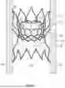 Fig. 05 - DELIVERY APPARATUS AND METHODS FOR IMPLANTING PROSTHETIC DEVICES