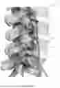 Fig. 02 - Spinal disc implant and device and method for percutaneous delivery of the spinal disc implant