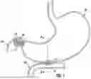 Fig. 02 - ANTI-MIGRATION STENT