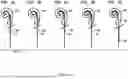 Fig. 07 - ADVANCED COCHLEA ACCESS