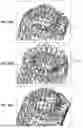 Fig. 35 - INVERTING MECHANICAL THROMBECTOMY APPARATUSES