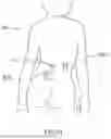 Fig. 15 - EXTERNAL ADJUSTMENT DEVICE FOR DISTRACTION DEVICE
