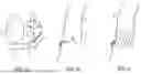 Fig. 02 - DEVICE AND METHOD WITH REDUCED PACEMAKER RATE IN HEART VALVE REPLACEMENT