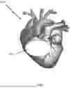 Fig. 02 - DEVICES AND METHODS FOR FORMING GUIDED ANGIOGENESIS AND ENHANCED VASCULARIZATION IN HEART TISSUE