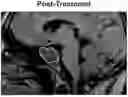 Fig. 01 - METHODS FOR SHRINKING PITUITARY TUMORS