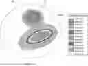 Fig. 01 - ACCOMMODATING CAVITY LENS SHAPED WITH PHOTOCLEAVABLE INSERT
