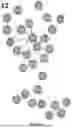 Fig. 100 - METHODS AND SYSTEMS FOR MACHINE LEARNING ANALYSIS OF SINGLE NUCLEOTIDE POLYMORPHISMS IN LUPUS