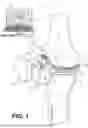 Fig. 02 - Tilting Surgical Tensor To Support At Least One Bone Cut