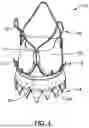 Fig. 02 - REPLACEMENT HEART VALVE SYSTEM WITH ANTI-MIGRATION ELEMENT