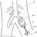 Fig. 01 - TEMPORARY BLOOD VESSEL OCCLUSION DEVICE AND METHOD