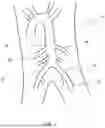Fig. 02 - TEMPORARY BLOOD VESSEL OCCLUSION DEVICE AND METHOD