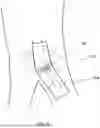Fig. 09 - TEMPORARY BLOOD VESSEL OCCLUSION DEVICE AND METHOD
