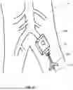 Fig. 10 - TEMPORARY BLOOD VESSEL OCCLUSION DEVICE AND METHOD