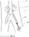 Fig. 12 - TEMPORARY BLOOD VESSEL OCCLUSION DEVICE AND METHOD