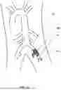 Fig. 13 - TEMPORARY BLOOD VESSEL OCCLUSION DEVICE AND METHOD