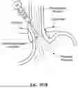 Fig. 255 - HANDED SPIRAL SLOTTED SCALPET ARRAY