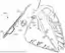 Fig. 01 - SHUNTING CATHETERS