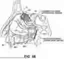 Fig. 05 - Systems and methods for therapeutic nasal treatment using handheld device