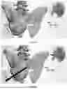 Fig. 44 - INSTRUMENTS AND METHODS FOR POSTERIOR SURGICAL APPROACH FOR SACROILIAC JOINT