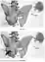 Fig. 46 - INSTRUMENTS AND METHODS FOR POSTERIOR SURGICAL APPROACH FOR SACROILIAC JOINT