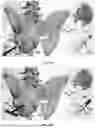 Fig. 47 - INSTRUMENTS AND METHODS FOR POSTERIOR SURGICAL APPROACH FOR SACROILIAC JOINT