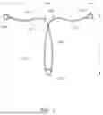 Fig. 02 - Intrauterine Contraceptive Device