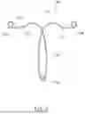 Fig. 06 - Intrauterine Contraceptive Device