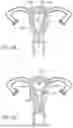 Fig. 07 - Intrauterine Contraceptive Device