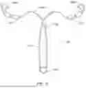 Fig. 08 - Intrauterine Contraceptive Device