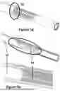 Fig. 43 - CARDIAC LEAD EXTRACTION DEVICE