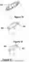 Fig. 48 - CARDIAC LEAD EXTRACTION DEVICE