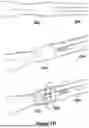 Fig. 96 - CARDIAC LEAD EXTRACTION DEVICE