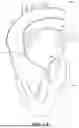 Fig. 02 - ADJUSTABLE ENDOLUMENAL IMPLANT FOR RESHAPING THE MITRAL VALVE ANNULUS