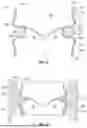 Fig. 33 - PROSTHETIC VALVES WITH EVERTING ANCHORS