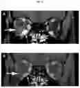 Fig. 20 - METHODS FOR THE TREATMENT OF THYROID EYE DISEASE