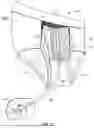 Fig. 24 - Devices, Systems, and Methods for Stabilizing Medical Tubing Protruding from a Patient