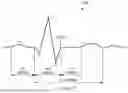 Fig. 03 - ECG INTERFERENCE SUPPRESSION