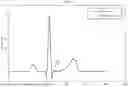 Fig. 04 - ECG INTERFERENCE SUPPRESSION