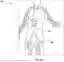 Fig. 07 - LOW PROFILE BALLOON CATHETER DELIVERY SYSTEM