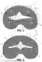 Fig. 03 - SYSTEMS AND METHODS FOR KNEE ARTHROPLASTY