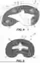 Fig. 04 - SYSTEMS AND METHODS FOR KNEE ARTHROPLASTY