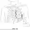 Fig. 02 - SUPRAVENTRICULAR TACHYARRHYTHMIA DISCRIMINATION