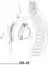 Fig. 03 - SUPRAVENTRICULAR TACHYARRHYTHMIA DISCRIMINATION