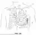 Fig. 04 - SUPRAVENTRICULAR TACHYARRHYTHMIA DISCRIMINATION