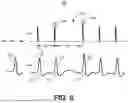 Fig. 10 - SUPRAVENTRICULAR TACHYARRHYTHMIA DISCRIMINATION