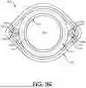 Fig. 05 - CATHETERS WITH REINFORCED SHEATH HAVING A COUPLED TUBE