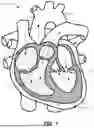 Fig. 02 - Heart Valve Replacement