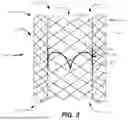 Fig. 04 - Heart Valve Replacement