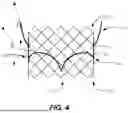 Fig. 05 - Heart Valve Replacement