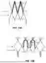 Fig. 15 - Heart Valve Replacement